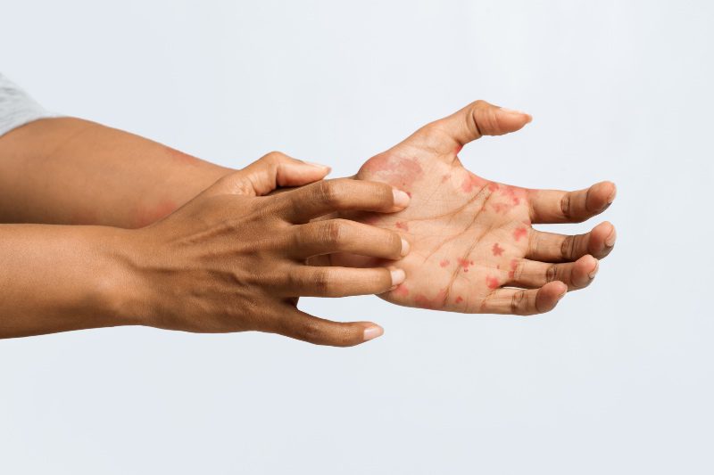 Nexus Letters for Veterans with Skin Conditions 8 Nexus Letters for Veterans with Skin Conditions