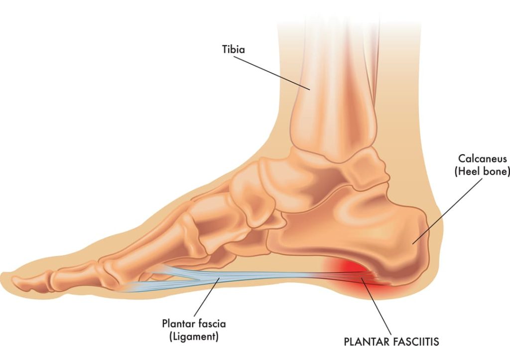 Plantar Fasciitis Infographic.